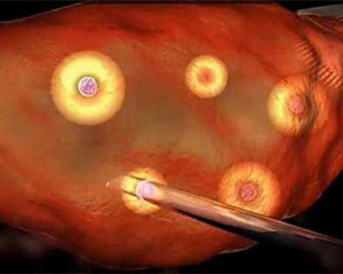 乌克兰供卵代孕套餐,试管婴儿检查中需要做宫腔镜吗-上海哪里可以做供卵_子宫